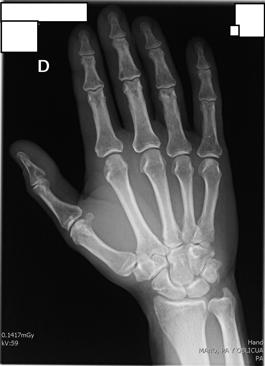 Radiografía PA mano 2